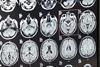 Trusts fail to keep up pace on stroke targets